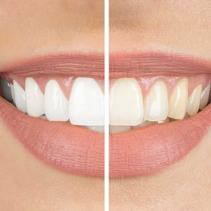 Teeth Whitening Before & After