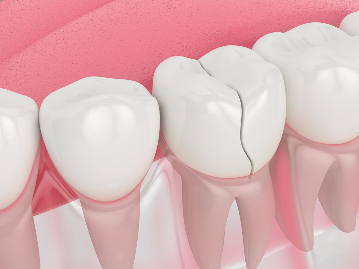 3d render of jaw with cracked tooth