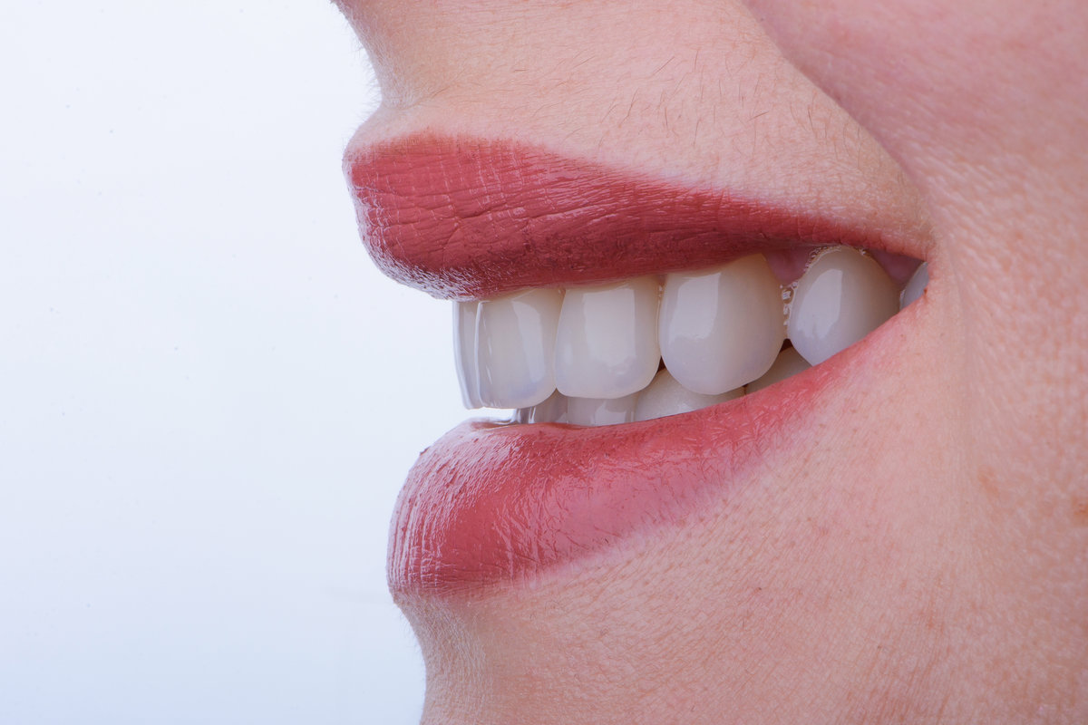 Female smile makeover by dental ceramic veneer, porcelain laminate veneers. Dental zirkonia crowns on upper jaw.